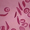 Glóbulos rojos de la sangre anormales.  Su forma semilunar dificulta en flujo normal de la sangre.